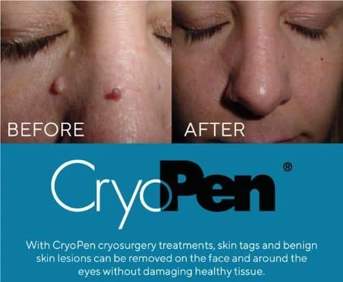 image of angiofibroma removal Stockwood using Lipo Sculpt cryopen!