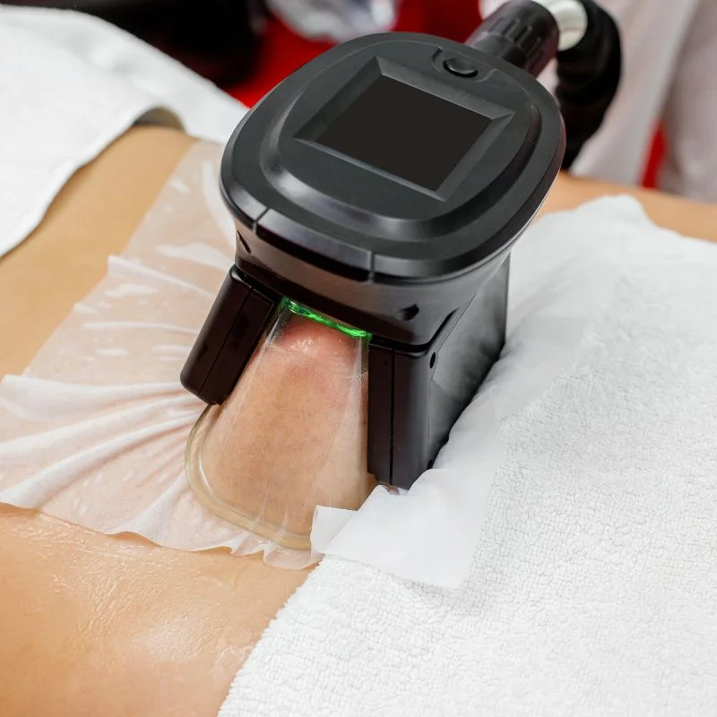 Fat Freezing treatment Stockwood